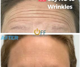 Anti-Wrinkle Injectable and Dermal-Fillers in Brighton