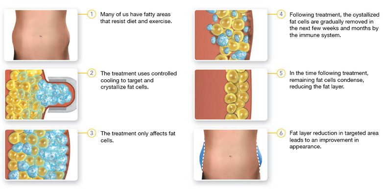 Expert  Fat Freezing / Cryolipolysis in Brighton & Hove