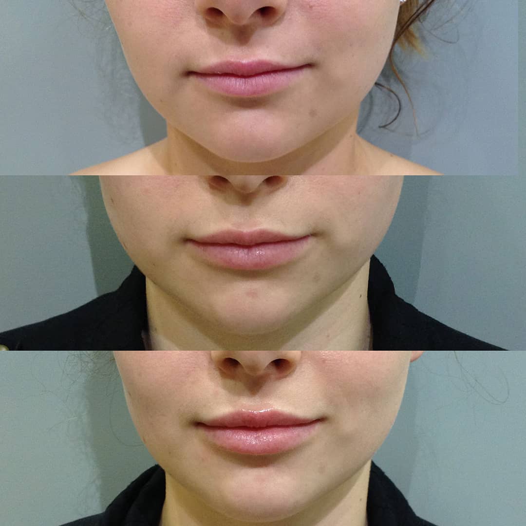 плоский бантик губы до и после фото