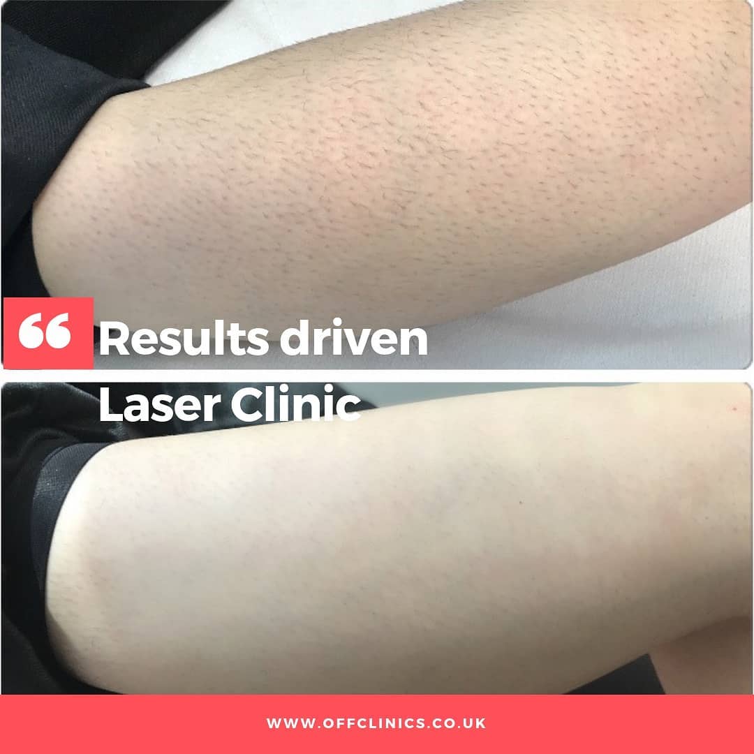 Laser Tattoo Removal  Laser and Skin