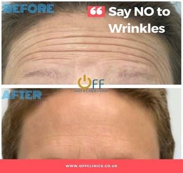 Expert  Anti-Wrinkle & Botox  in Brighton & Hove