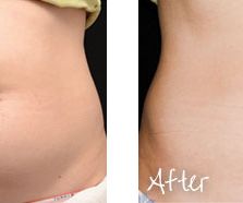 img_area_body_fatreduction_coolsculpting_A