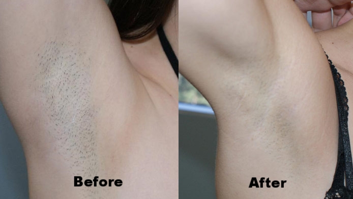 Electrolysis vs Laser Hair Removal: Which Method Should I Choose?